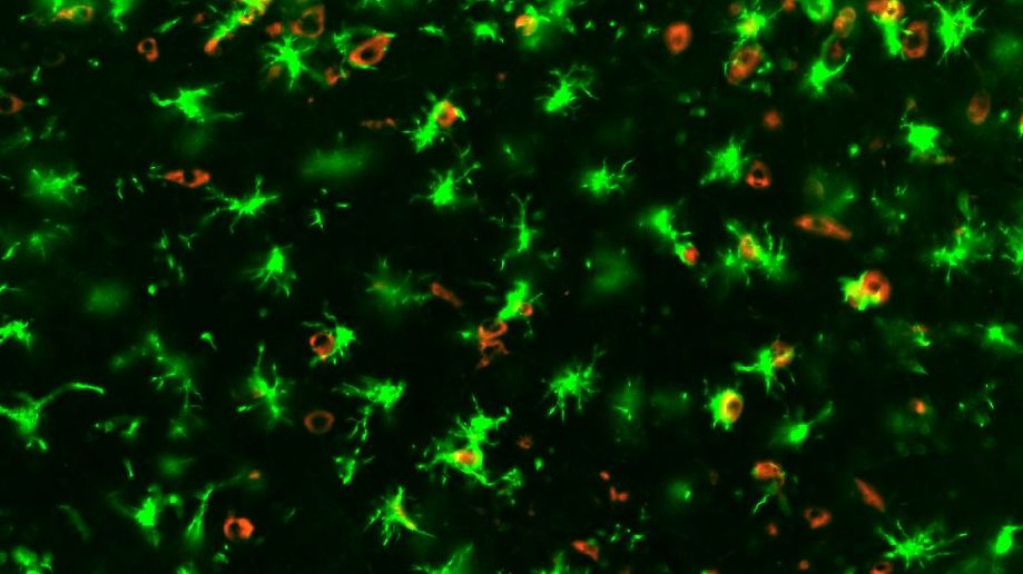 A Covid-19 infected mouse brain showing 'angry' microglia in green and SARS-CoV-2 in red. | Image source: Supplied by UQ